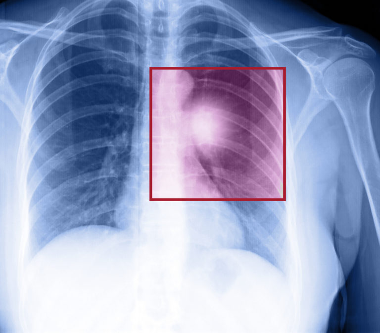 Unusual Signs of Lung Cancer You Should Not Ignore